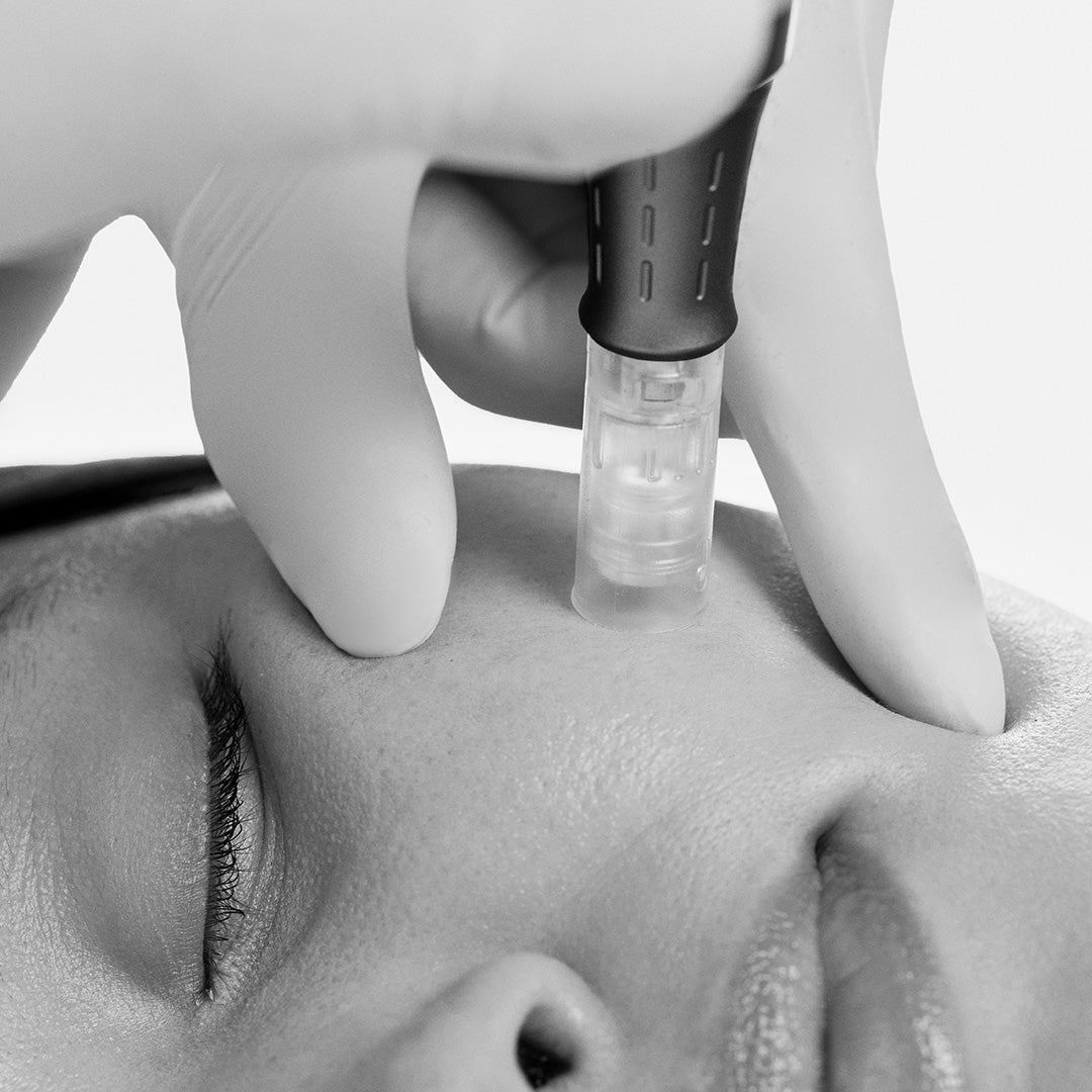 MICRONEEDLING